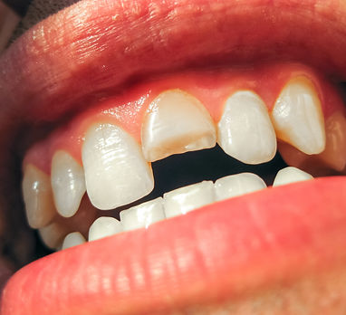 Broken tooth