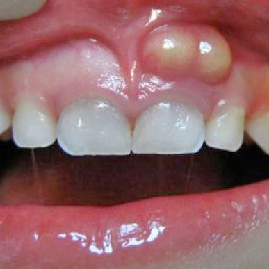 Infected tooth