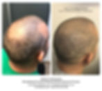 Scalp Micropigmentation SMP by El Trucha