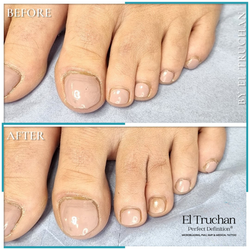 Syndactyly Medical Tattoo Before and After
