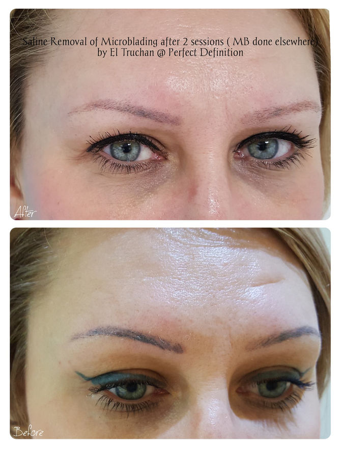 Saline Removal of Microblading after 2 sessions (MB done elsewhere) by El Truchan @ Perfect Definiti