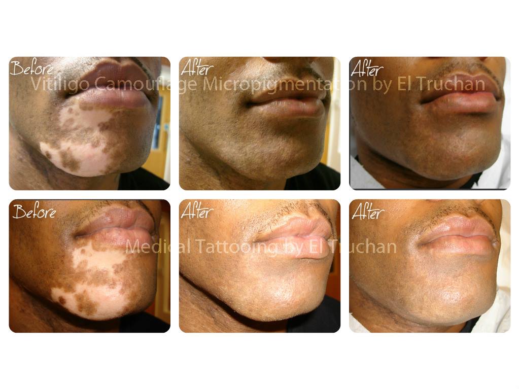 Medical Tattoo / Permanent Cosmetics treatment Vitiligo Microblading