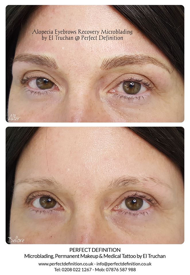 Alopecia Eyebrows Recovery Microblading by El Truchan @ Perfect Definition