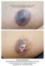 Nipple & Areola Restoration Medical Tatt