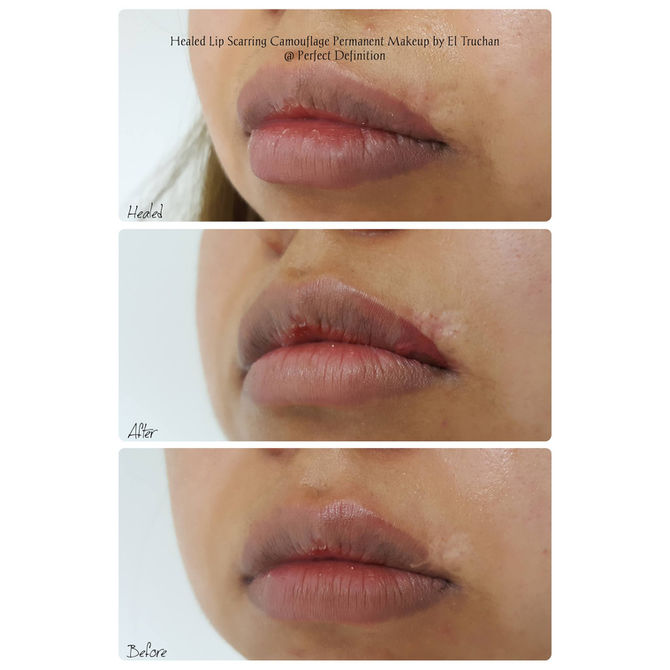 Healed Lip Scarring Camouflage Permanent Makeup by El Truchan @ Perfect Definition