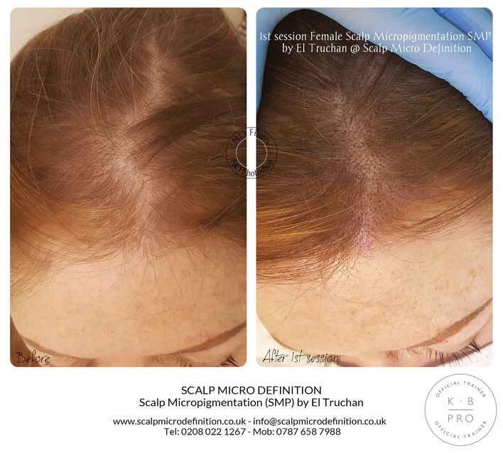 1st session Female Scalp Micropigmentation SMP Hair Tattoo by El Truchan @ Scalp Micro Definition