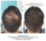 Healed after 3 sessions Scalp Micropigme