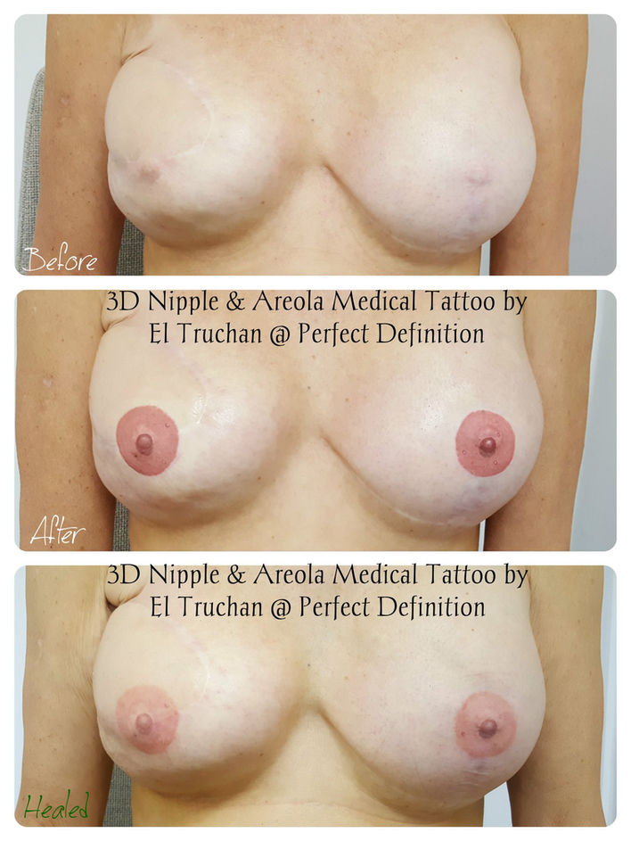 3D Nipple & Areola medical Tattoo by El Truchan @ Perfect Definition