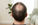Back of a man’s head showing hair thinning and male pattern hair loss at the crown.