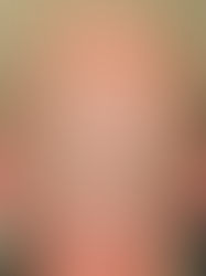 1st session Blond SMP Male Scalp Micropigmentation by El Truchan @ Scalp Micro Definition