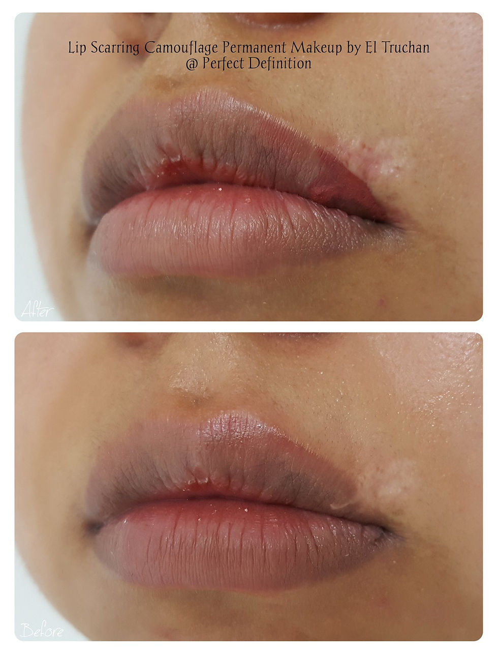 Lip Scarring Camouflage Permanent Makeup