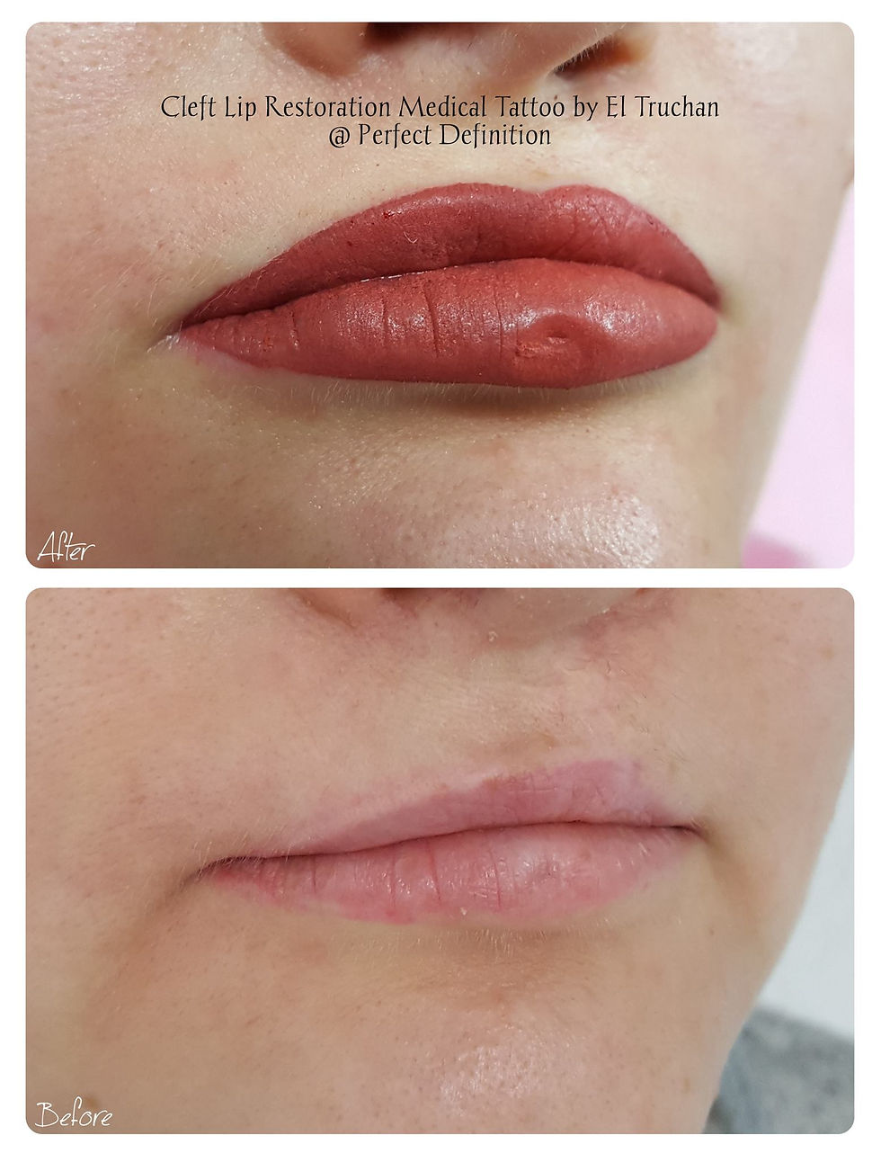 Cleft Lip Restoration Medical Tattoo