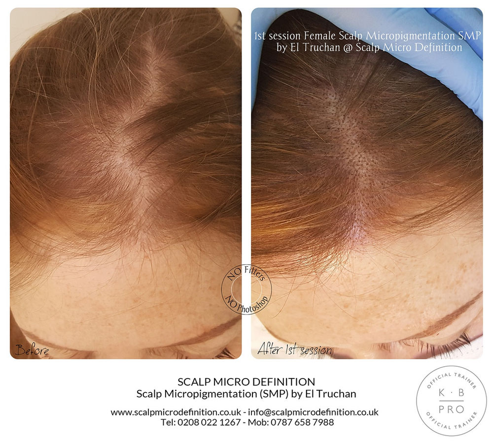 1st session Female Scalp Micropigmentation SMP Hair Tattoo by El Truchan @  Scalp Micro Definition