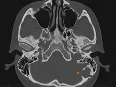 A Mystery in the Mastoid Bone: Intradiploic Epidermoid Cyst Case No: NR.1.5.1.2.002