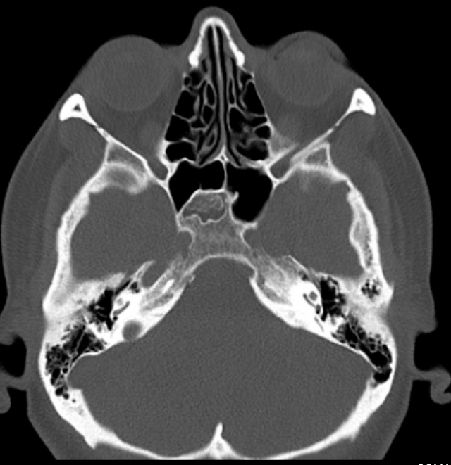 incomplete or halted normal sinus pneumatization
