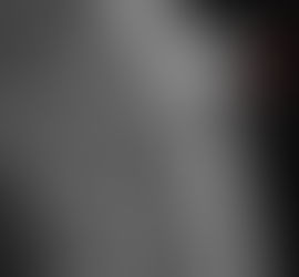 Epidermoid (Inclusion) Cyst – Multimodal Imaging