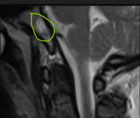 Hyperintense Lesion on T2W