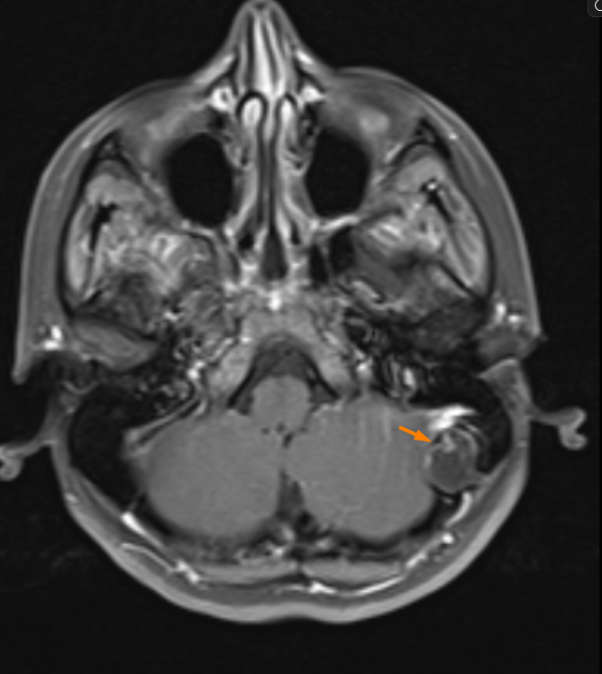 Post-contrast T1 FS Axial