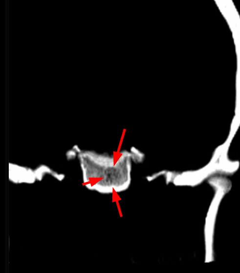 Polka-dot Pattern on CT(coronal)