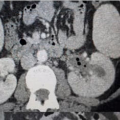Emphysematous Pyelitis – Radiological Findings and Differential Diagnosis