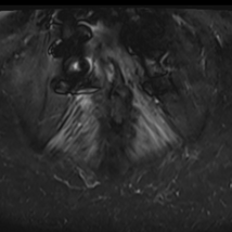 MRI: Symmetric edema in thoracis spinalis muscles