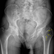 Rope Sign in Perthes Disease