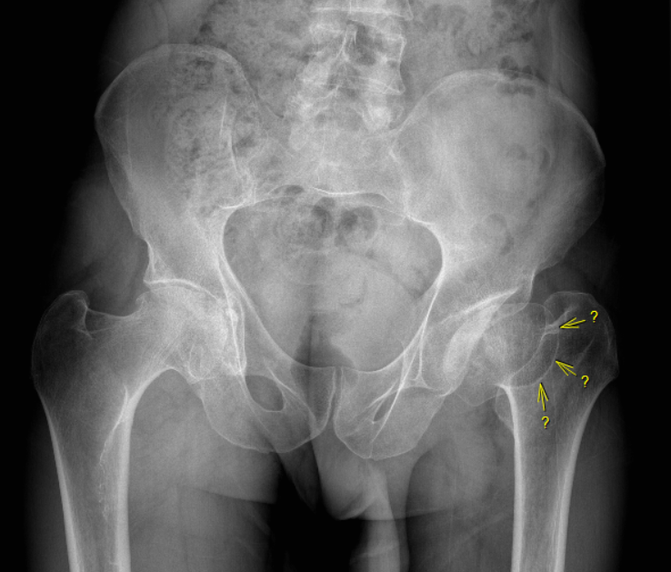 Rope Sign in Perthes Disease