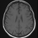 Pitfalls in Unenhanced MRI: Spotting Small Meningiomas with Subtle Radiologic Signs