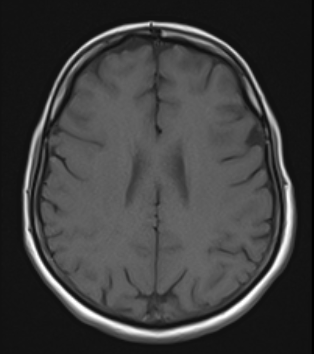 Pitfalls in Unenhanced MRI: Spotting Small Meningiomas with Subtle Radiologic Signs