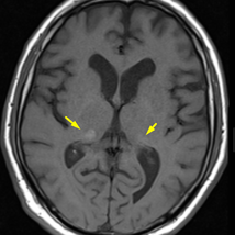 Fahr Disease and Fahr-like Calcifications (Secondary Fahr) – Professional Radiology Notes