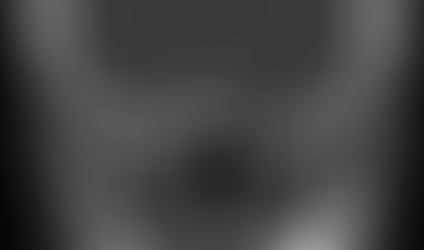 Punctate calcifications: Represent physiological trabecular mineralization