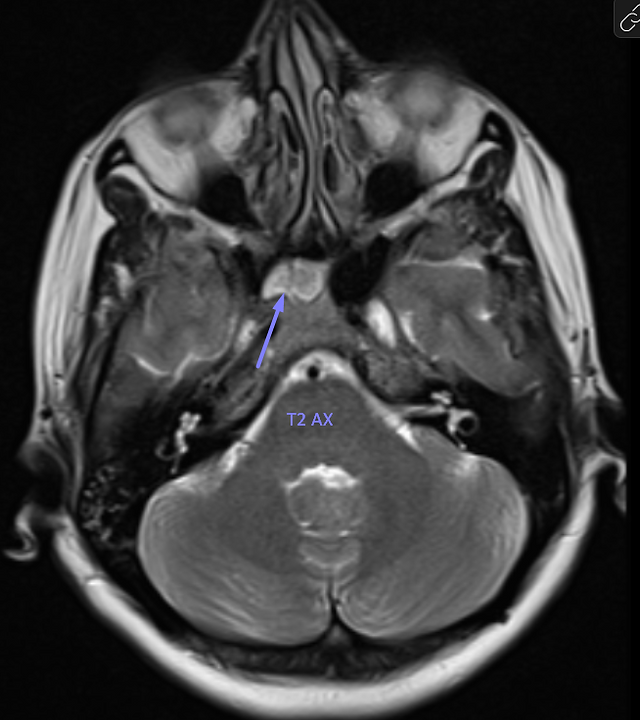 Peripheral hyperintense on T1 and T2 → fibrous tissue or bone marrow interface
