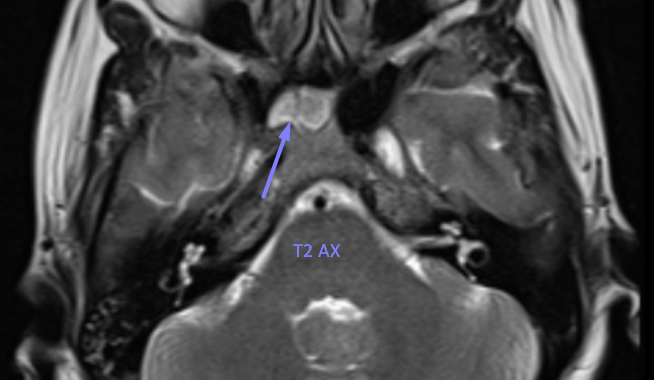 Peripheral hyperintense on T1 and T2 → fibrous tissue or bone marrow interface