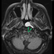 Atypical Hyperdense Thornwaldt Cyst with Lateral Extension