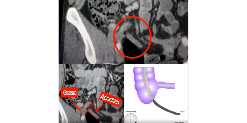 Ti Appendix Acute Appendicitis on CT: Key Imaging Findings Every Radiology Resident ...