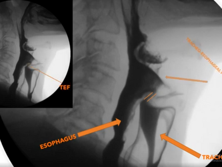 English Text:Tracheoesophageal Fistula (TEF) and Oral Contrast Esophagography Türkçe Metin:Trakeoözofageal Fistül (TÖF) ve Oral Kontrast Özefagografi