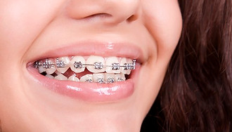 invisalign-vs-braces-girl-with-traditional-metal-braces.jpg