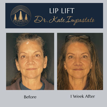 Lip lift before and after in Vancouver, WA showing natural upper lip enhancement at Evergreen Plastic Surgery in Salmon Creek.