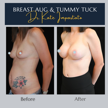 Angled view of tummy tuck and breast implant results in 31-year-old Portland area patient showing muscle repair and volume restoration