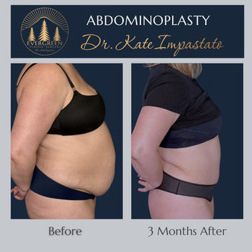 Before and after tummy tuck with liposuction showing improved waist contour in Vancouver WA