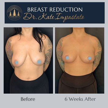 Natural breast lift before and after showing improved breast position and contour