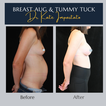 Side view of tummy tuck and breast augmentation results in young mom after mommy makeover near Portland OR