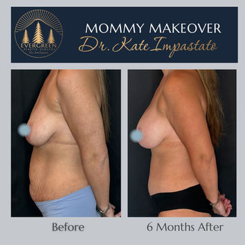 Before and after mommy makeover after pregnancy showing breast and abdominal rejuvenation in Vancouver WA