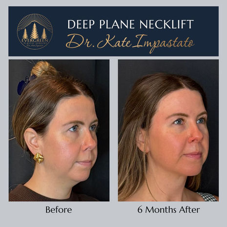 Before and after deep plane neck lift showing improved neck contour and jawline definition in Vancouver WA