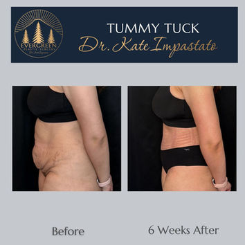 6 week tummy tuck results showing flatter abdomen and improved core in Vancouver WA