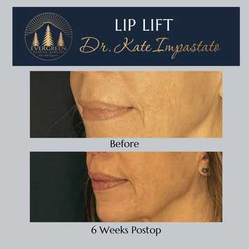 Oblique before and after of lip lift patient in Vancouver WA with natural enhancement and improved lip length