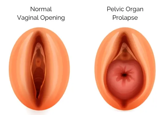 Inside a Mumbai Gynecology Practice Focused on Women’s Pelvic Health