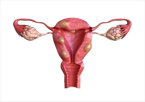 Uterine Fibroid Treatment in Thane
