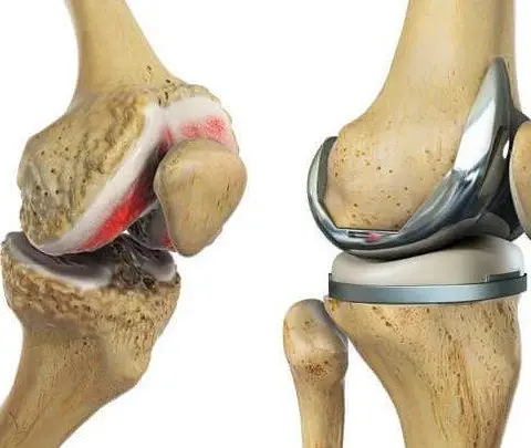 A Journalist’s Visit Inside a Leading Knee Replacement Practice in Bangalore