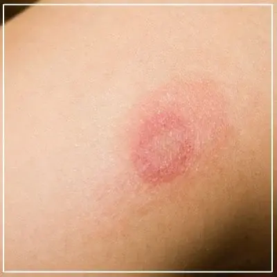 Get Expert Relief from Fungal Skin Infections